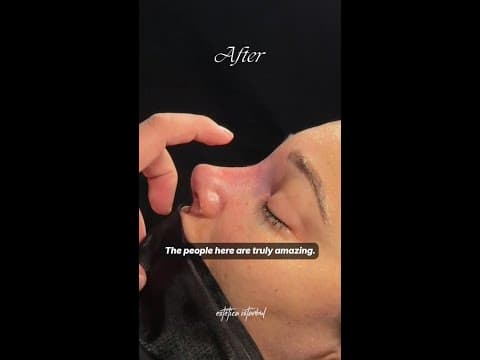 Catia's Rhinoplasty in Istanbul — Italian Patient Review