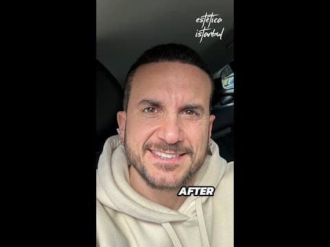 Italian Patient — Hair Transplant in Istanbul