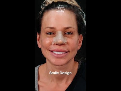 Polish Patient — Dental Transformation in Istanbul