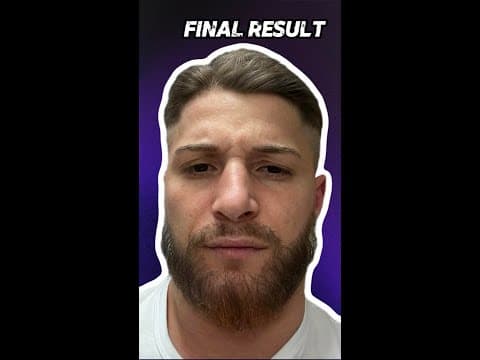 Beard Transplant in Istanbul — Patient Review