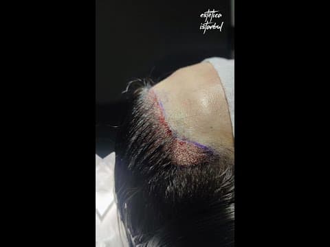 Female DHI Hair Transplant in Istanbul