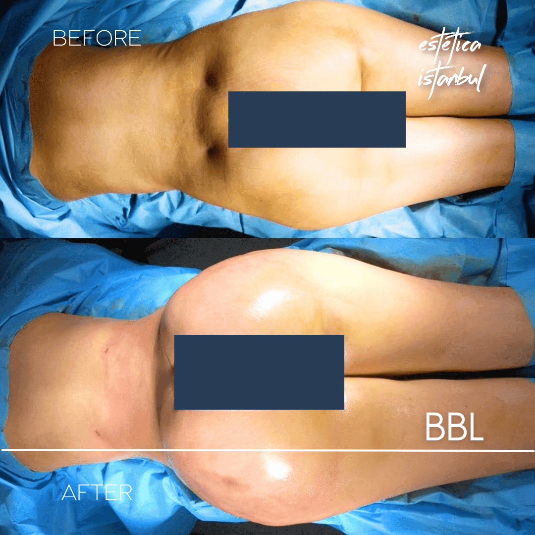 Başarısız BBL: BBL Revizyon Hazırlığı