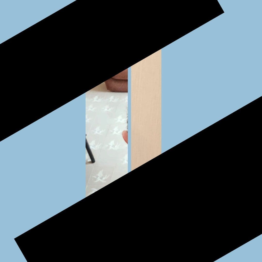 Hair Transplant Before & After