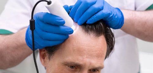 Trapianto di capelli senza cicatrici in Turchia