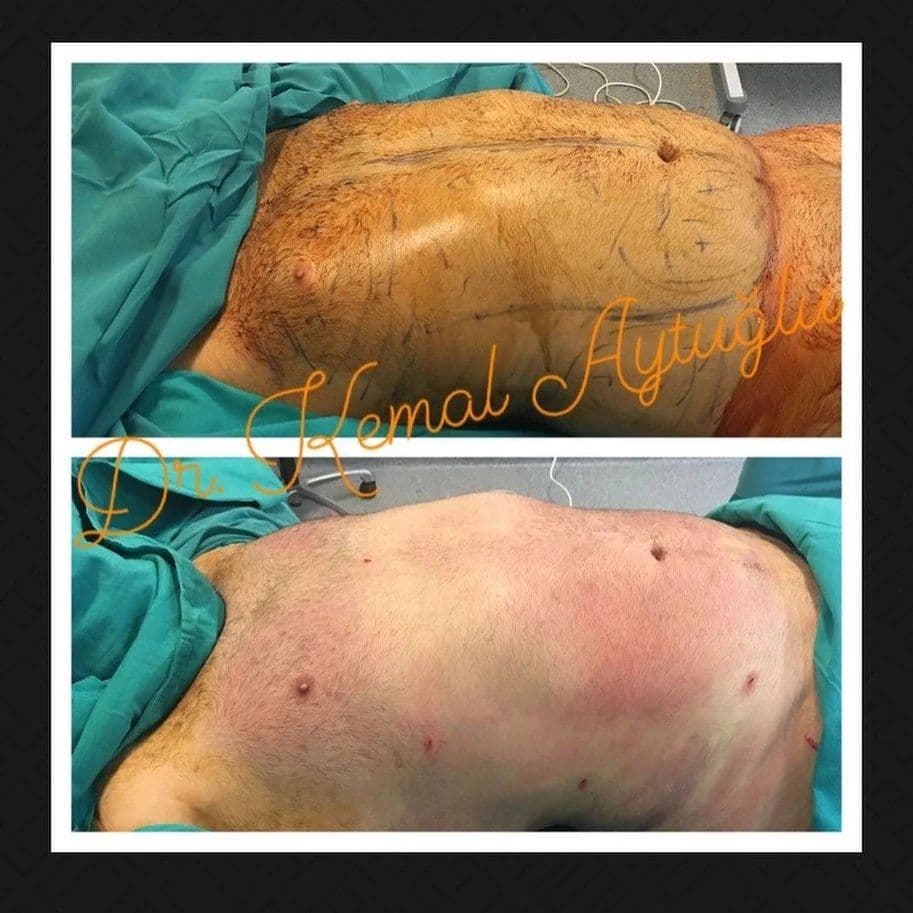 Liposuction vs Tummy Tuck: Which Body Contouring Procedure Is Right for You?