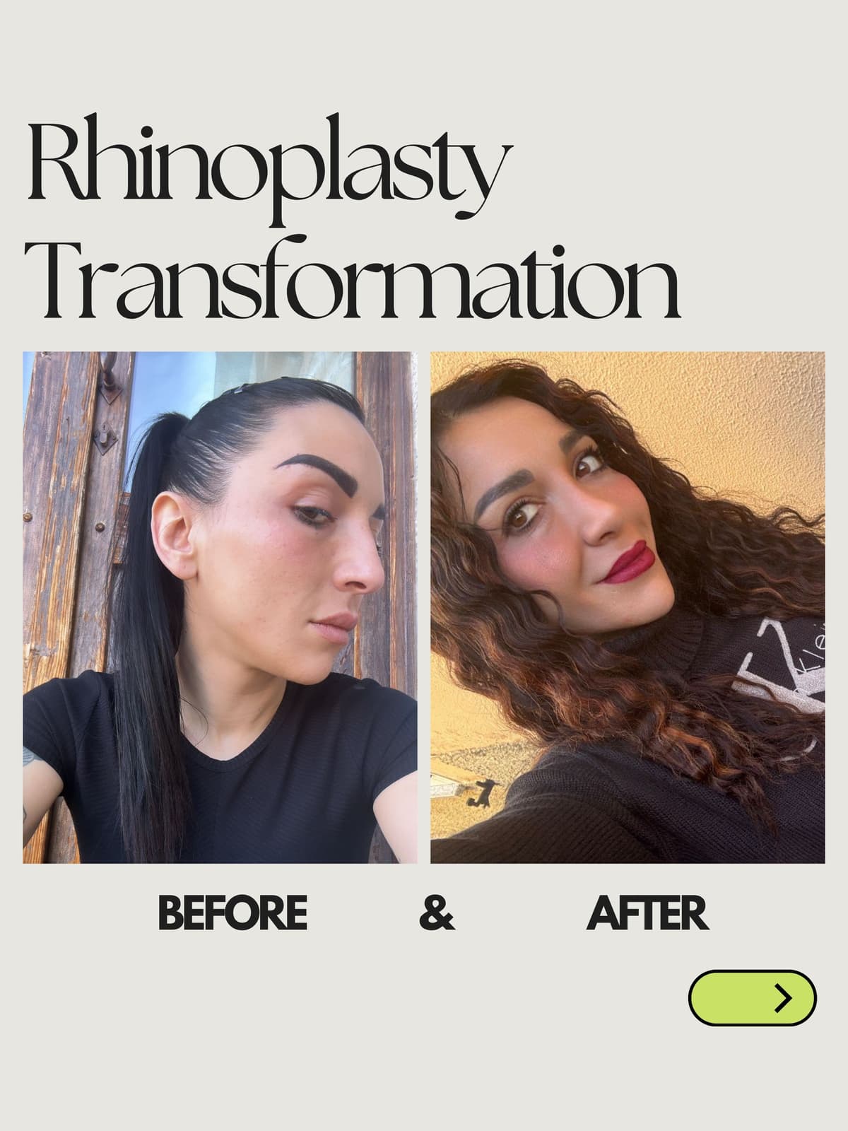 Rhinoplasty Transformation 6