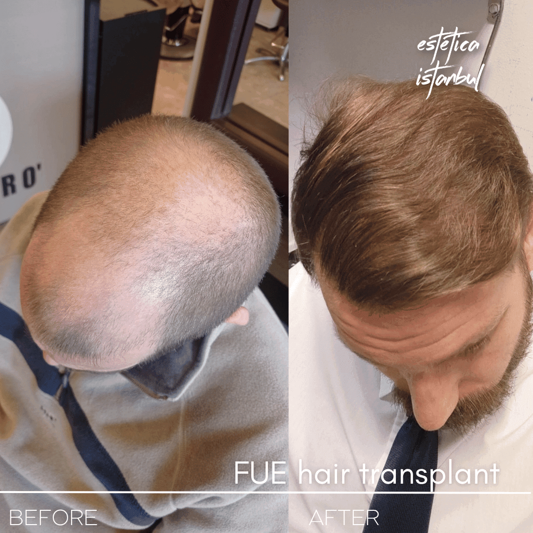 How to Find the Best Hair Transplant Clinic in Turkey