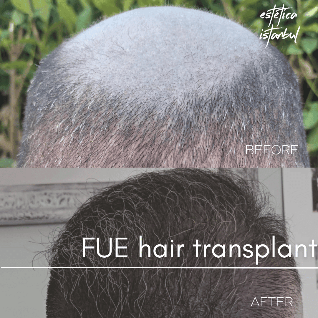 Hair Transplant Patient Reviews and Results
