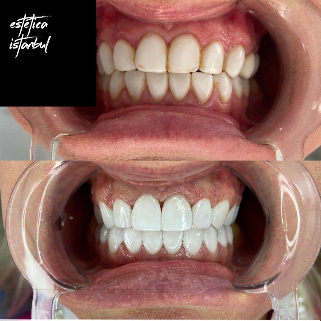 Hollywood Smile Before & After