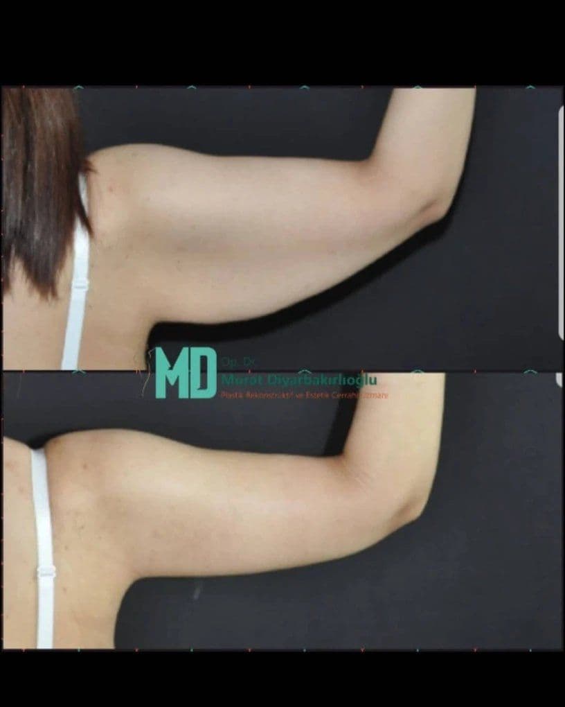 Arm Lift Before & After