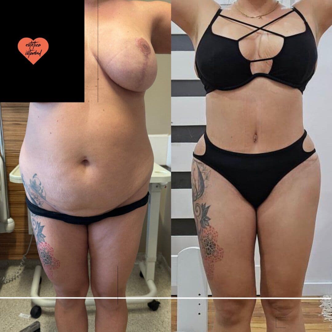 Mommy Makeover + Tummy Tuck Transformation