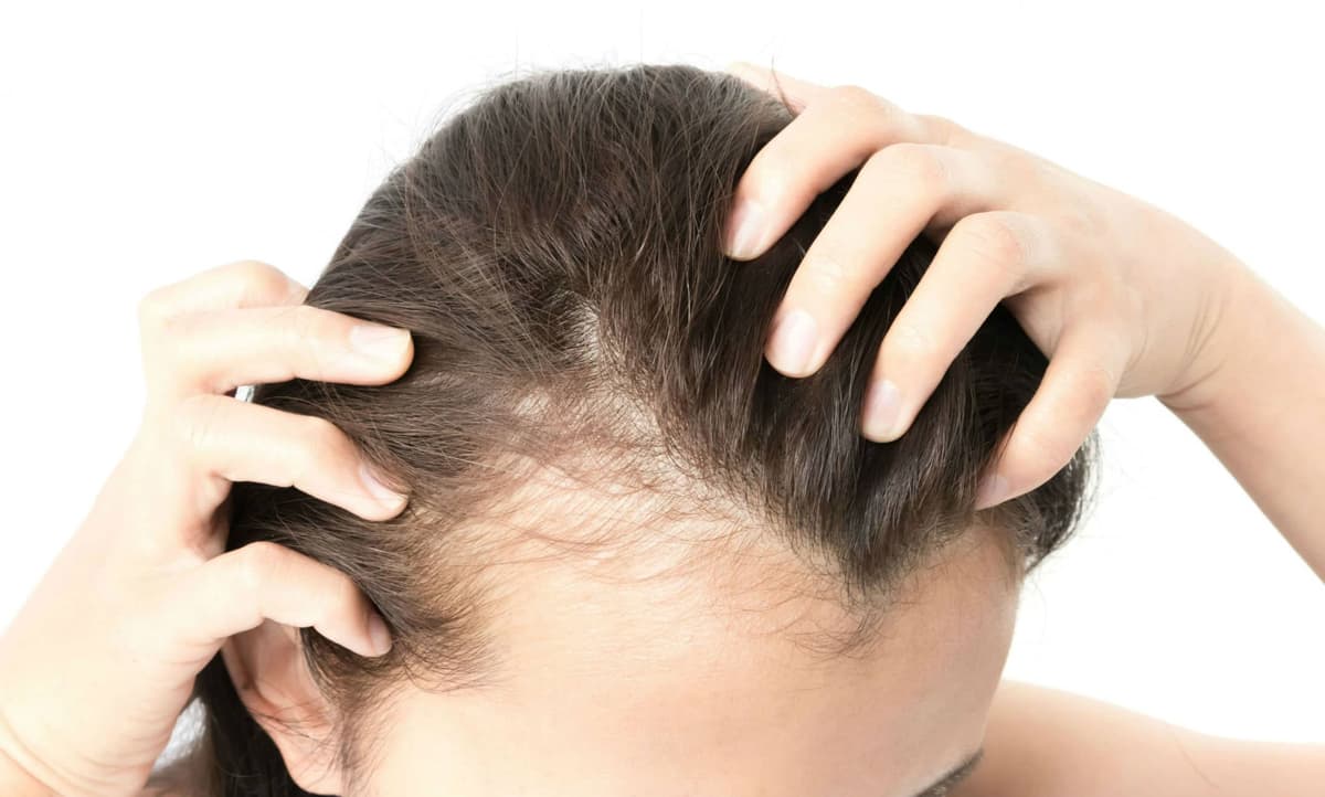 Female Hair Transplant in Istanbul — Estetica Istanbul