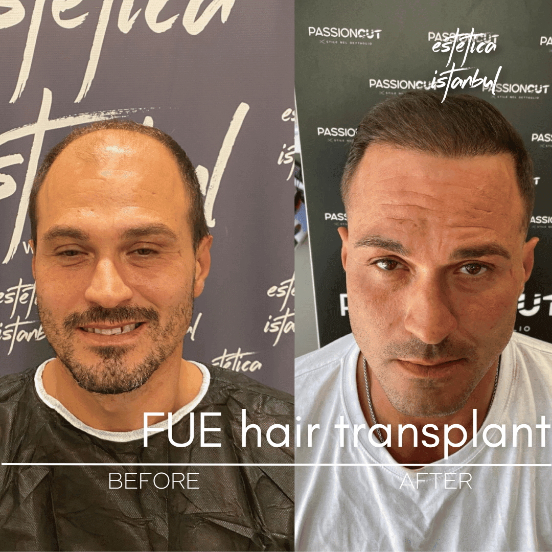 Can a Botched Hair Transplant Be Fixed?