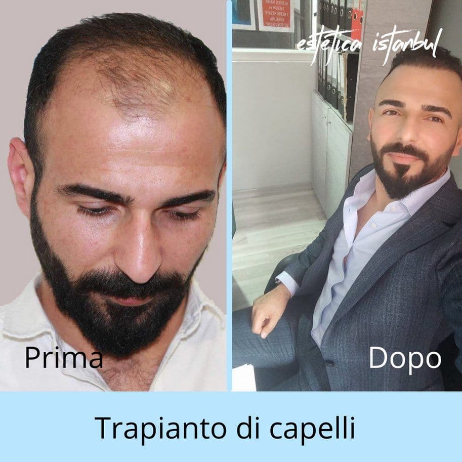 FUE vs DHI Haartransplantation: Welche Technik ist richtig für Sie?