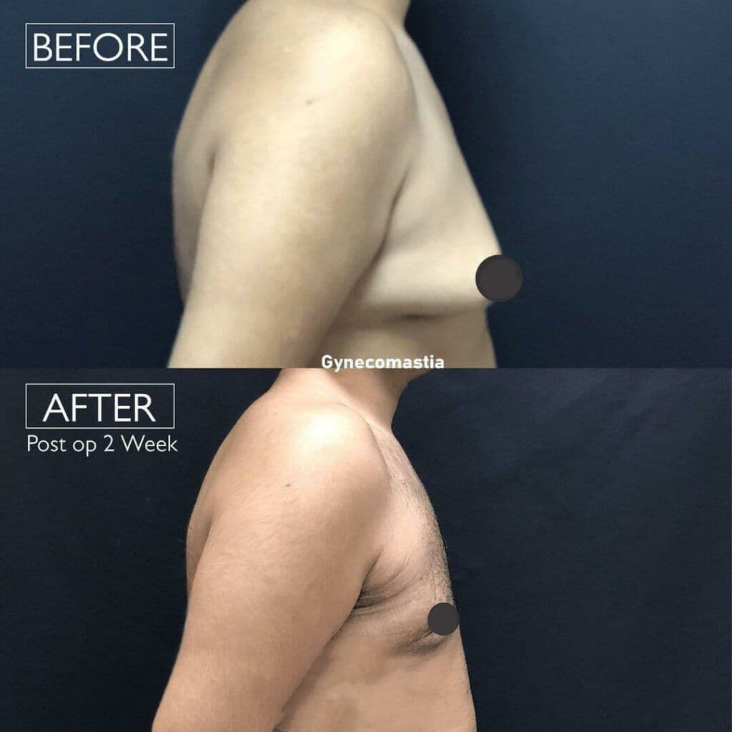 Gynecomastia Before & After Istanbul