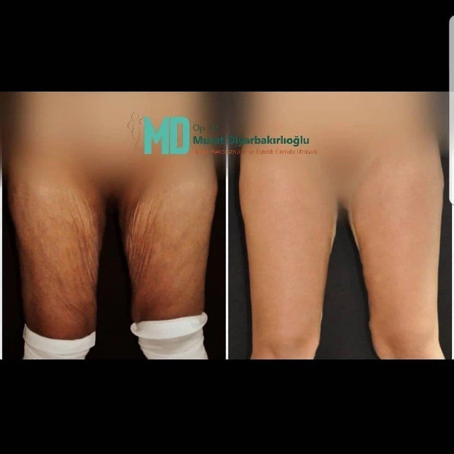 Thigh Lift Before & After