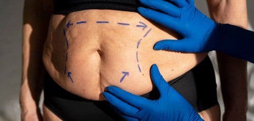 Nieudana plastyka brzucha: przyczyny i przyczyny Rozwiązania
