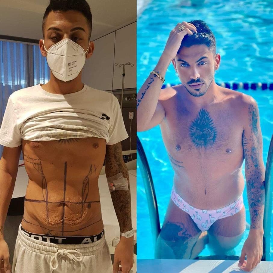 Body Lift Before & After