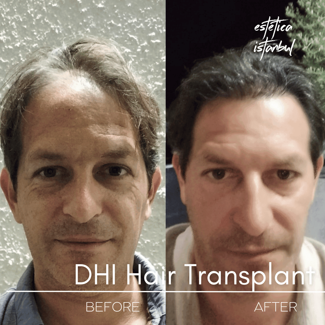 Hair Transplant Recovery Timeline: Month by Month Growth Guide