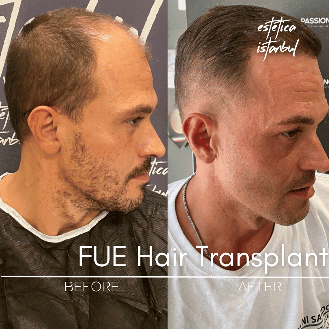 Find the Best Hair Transplant Surgeon in the World