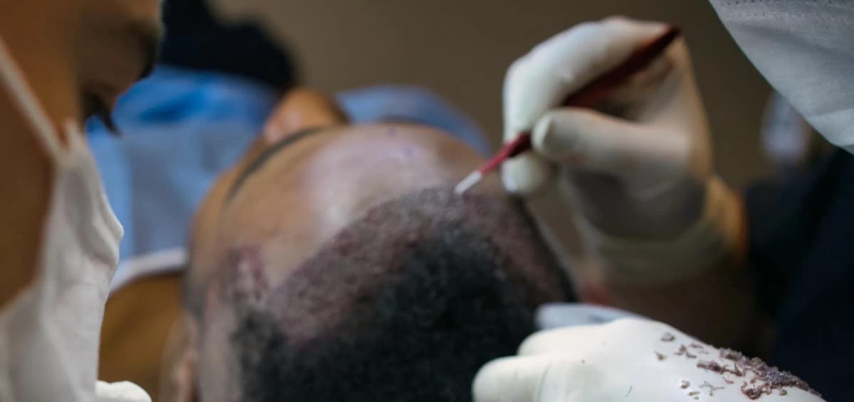 DHI Hair Transplant in Istanbul — Estetica Istanbul