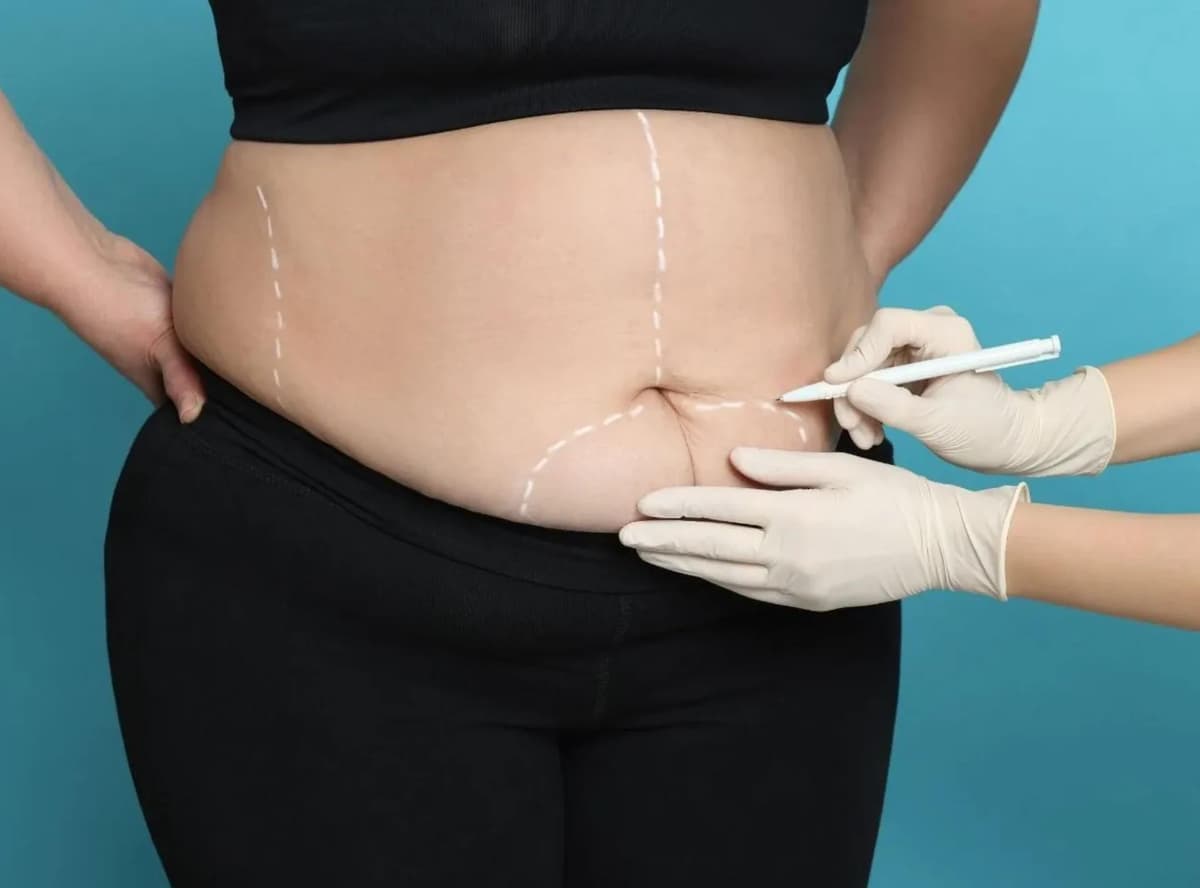 Post Bariatric Lift in Istanbul — Estetica Istanbul