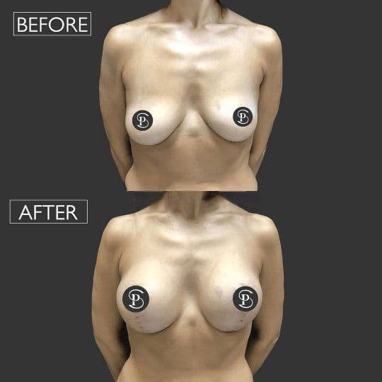Breast Lift Before & After