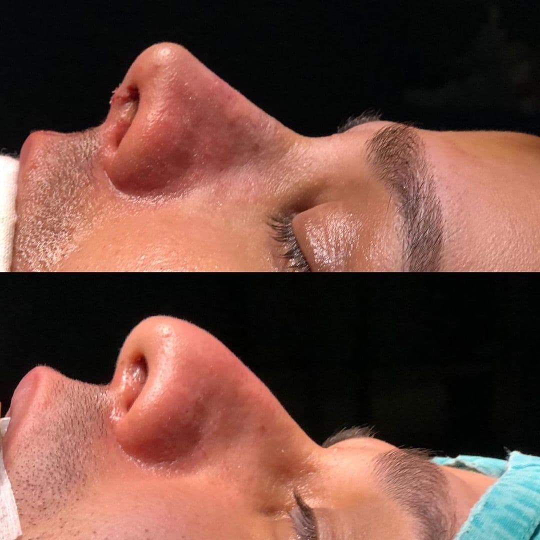 Male Rhinoplasty Before & After