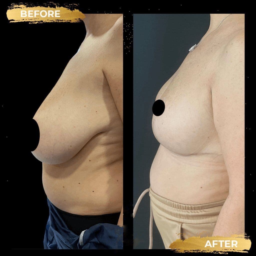 Breast Reduction Before & After