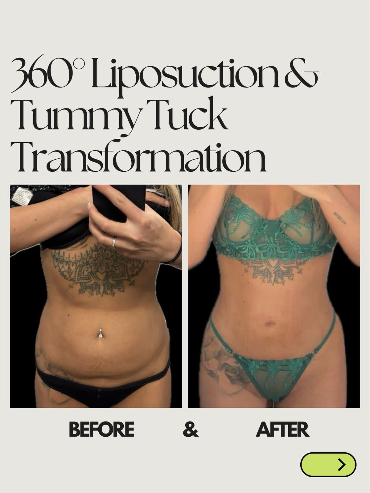 360 Liposuction & Tummy Tuck Transformation