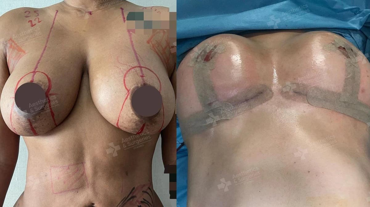 Which is Better Breast Lift or Breast Augmentation?