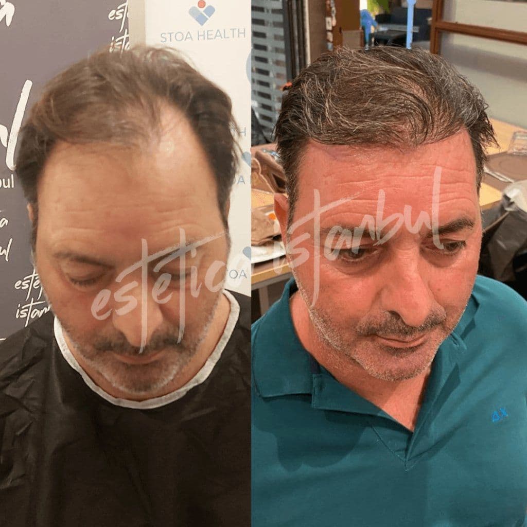 Risultati del trapianto di capelli: Prima e dopo - Cosa è realistico?