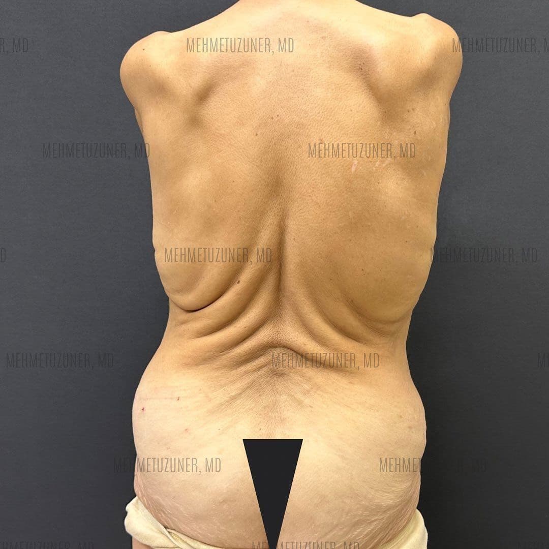 Gastric Sleeve Surgery in Istanbul: Complete Patient Guide