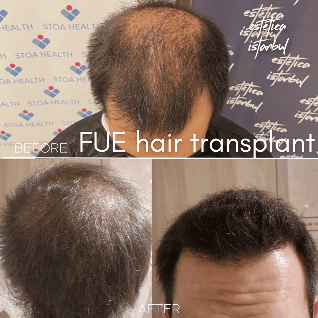How Many Graft Do I Need for Hair Transplant