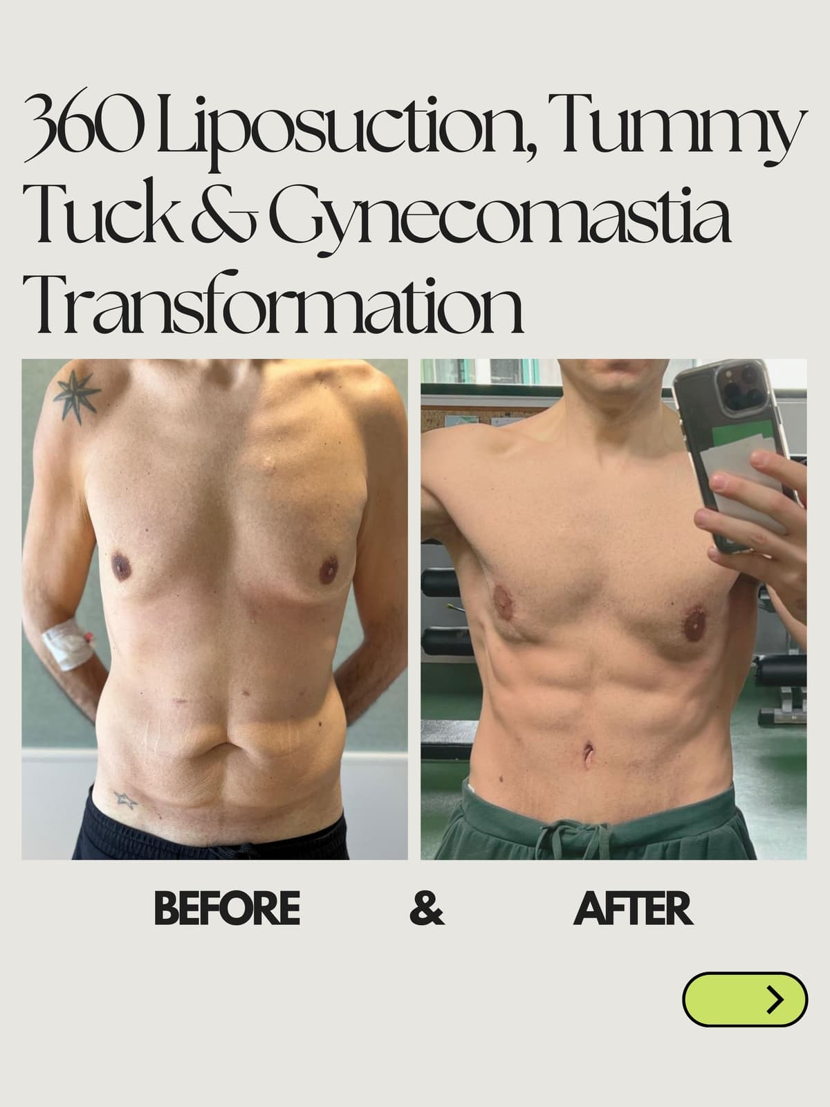 360 Liposuction Male Transformation