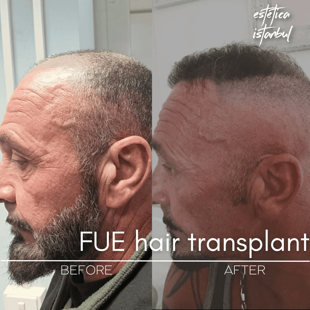 Crown Hair Transplant Turkey