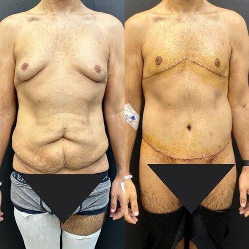 Male Bariatric Surgery Before & After Turkey