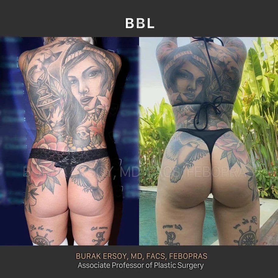 BBL Safety: How Istanbul's Top Surgeons Minimize Risk