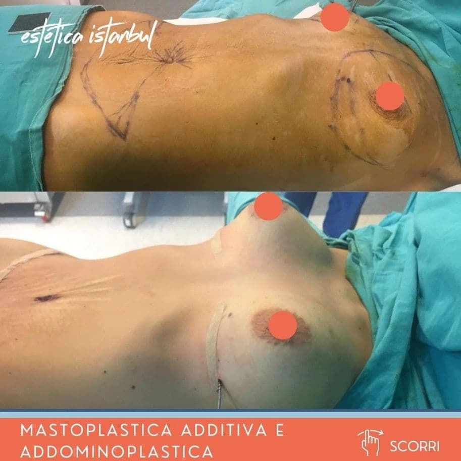 Recupero dalla liposcultura addominale: La tua guida completa settimanale (2026)