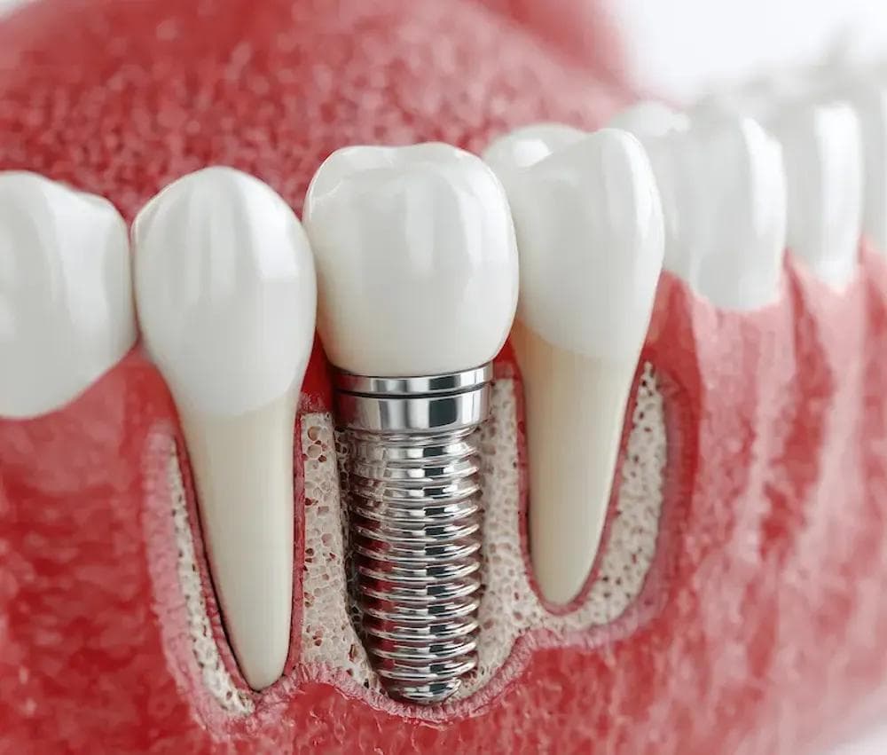 Dental Implants in Istanbul — Estetica Istanbul