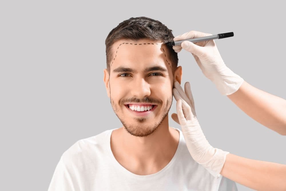FUE Hair Transplant in Istanbul — Estetica Istanbul