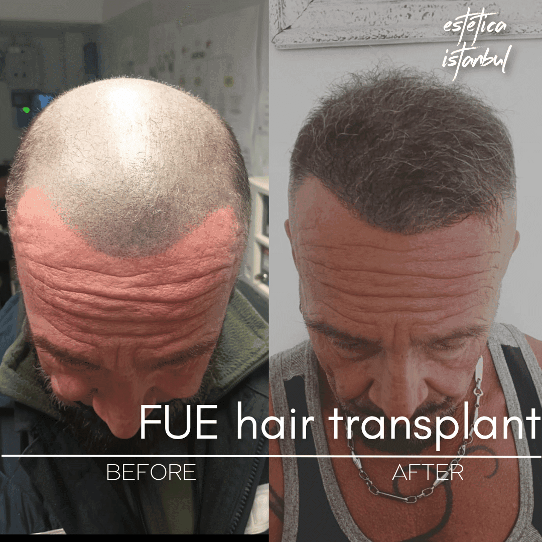Front Hairline Design in Hair Transplantation