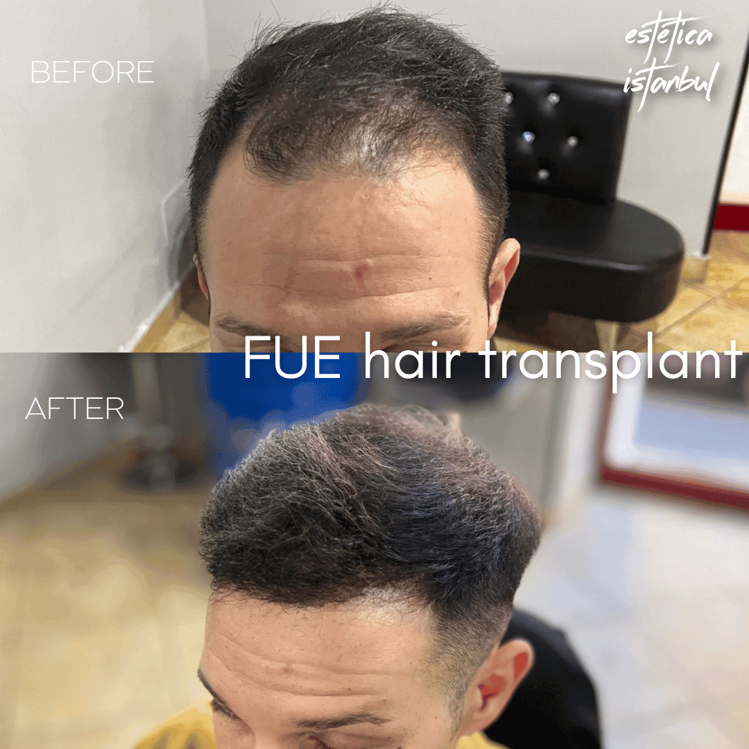 Does Hair Transplants Painful?