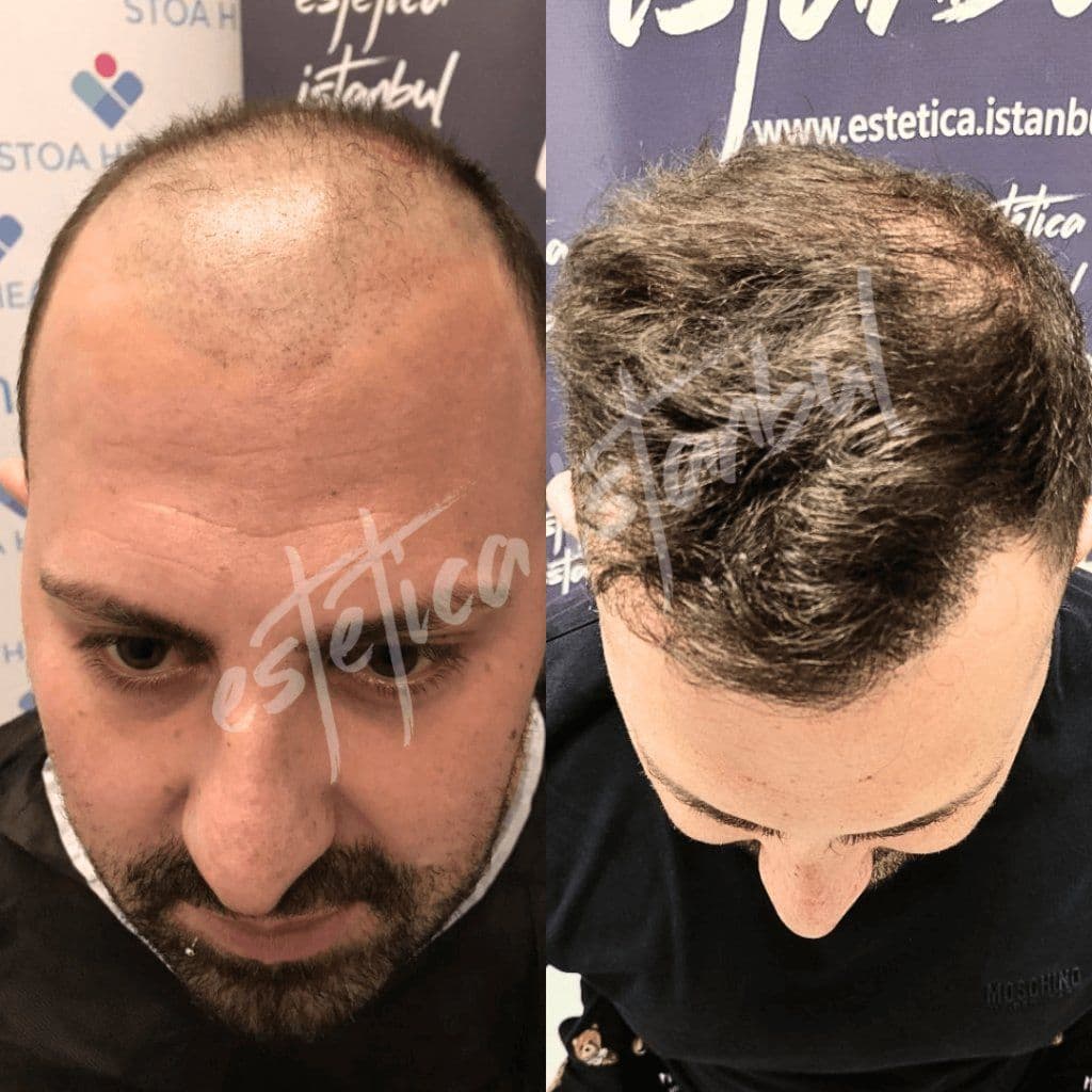 Lohnt sich eine Haartransplantation? Eine ehrliche Kosten-Nutzen-Analyse