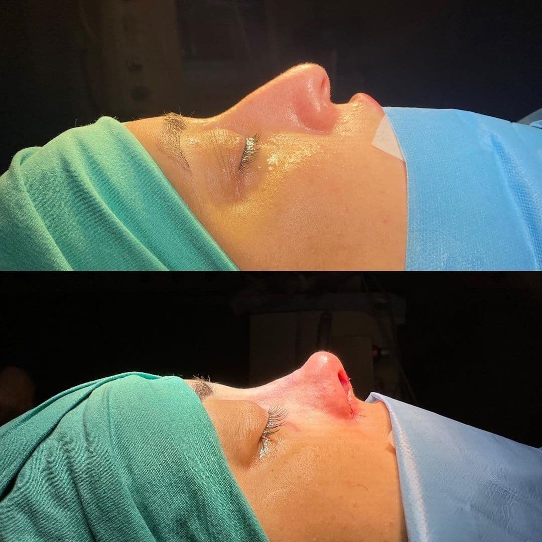 Botched Facelift: What You Need to Know Before Your Surgery