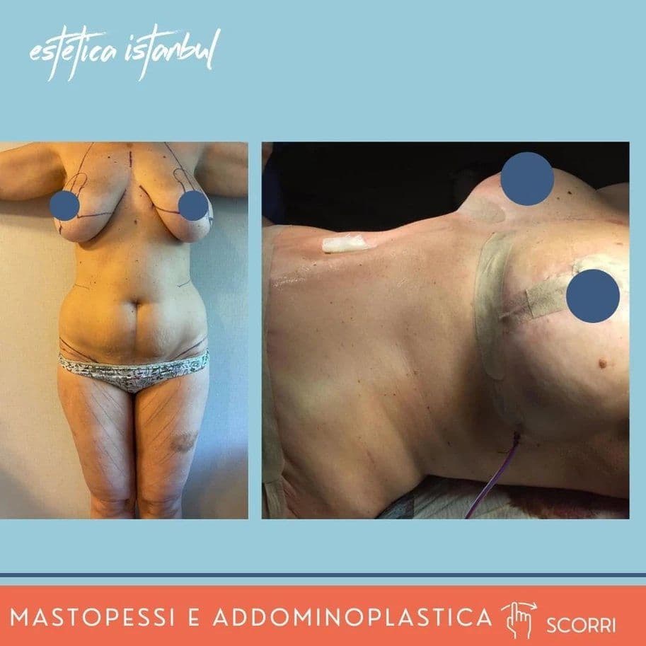 Tummy Tuck Before & After