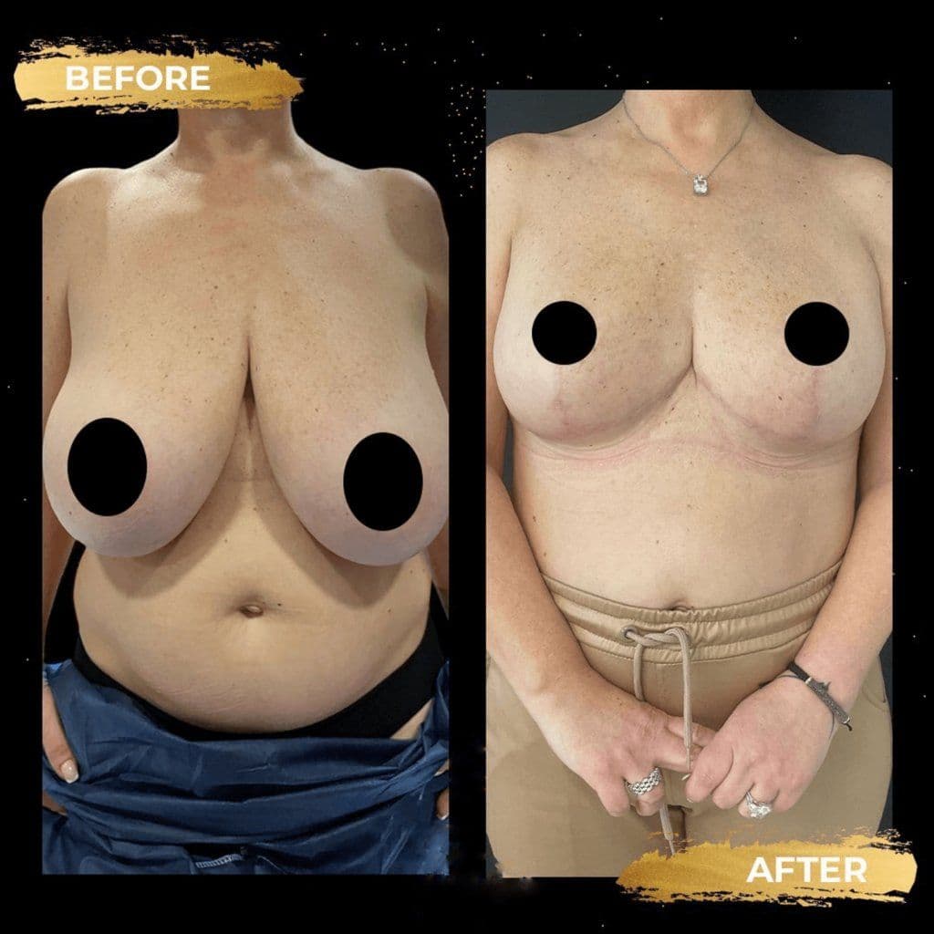 Breast Reduction Before & After