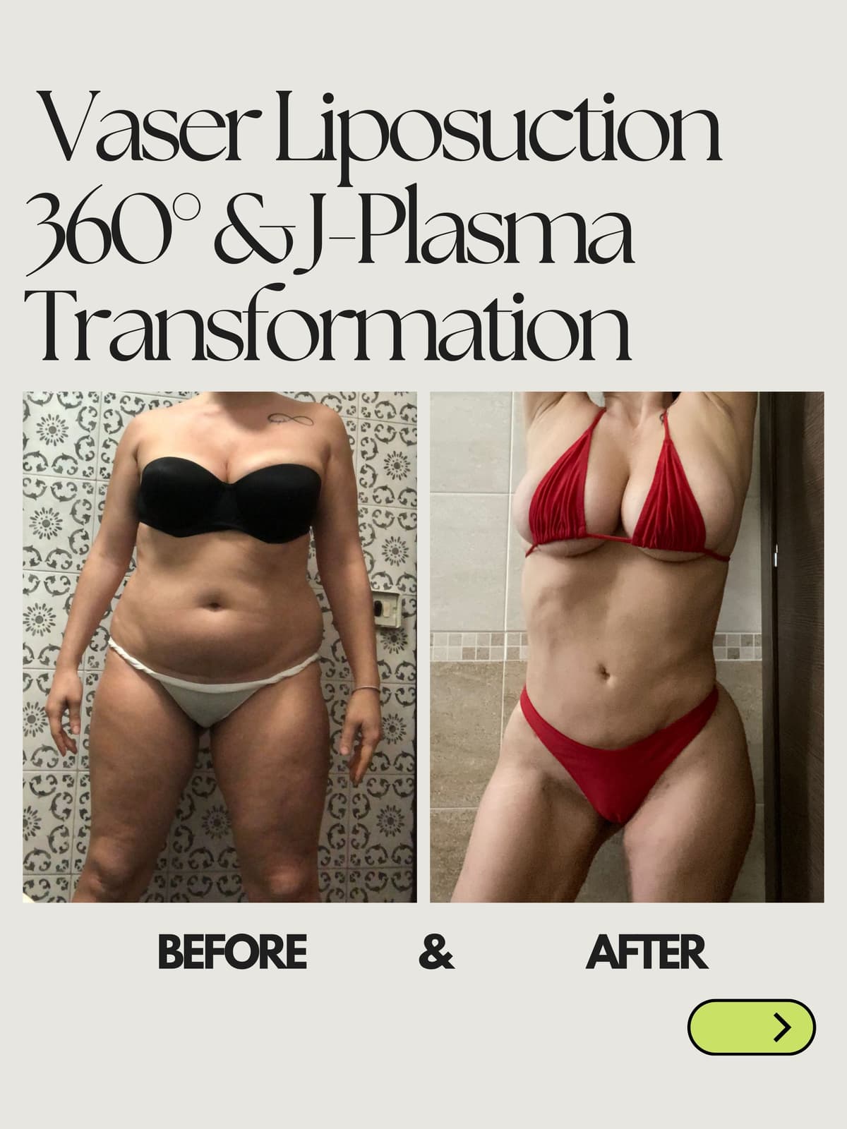 360 Liposuction Transformation 2
